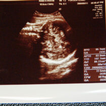 ultrasonography　　38W
